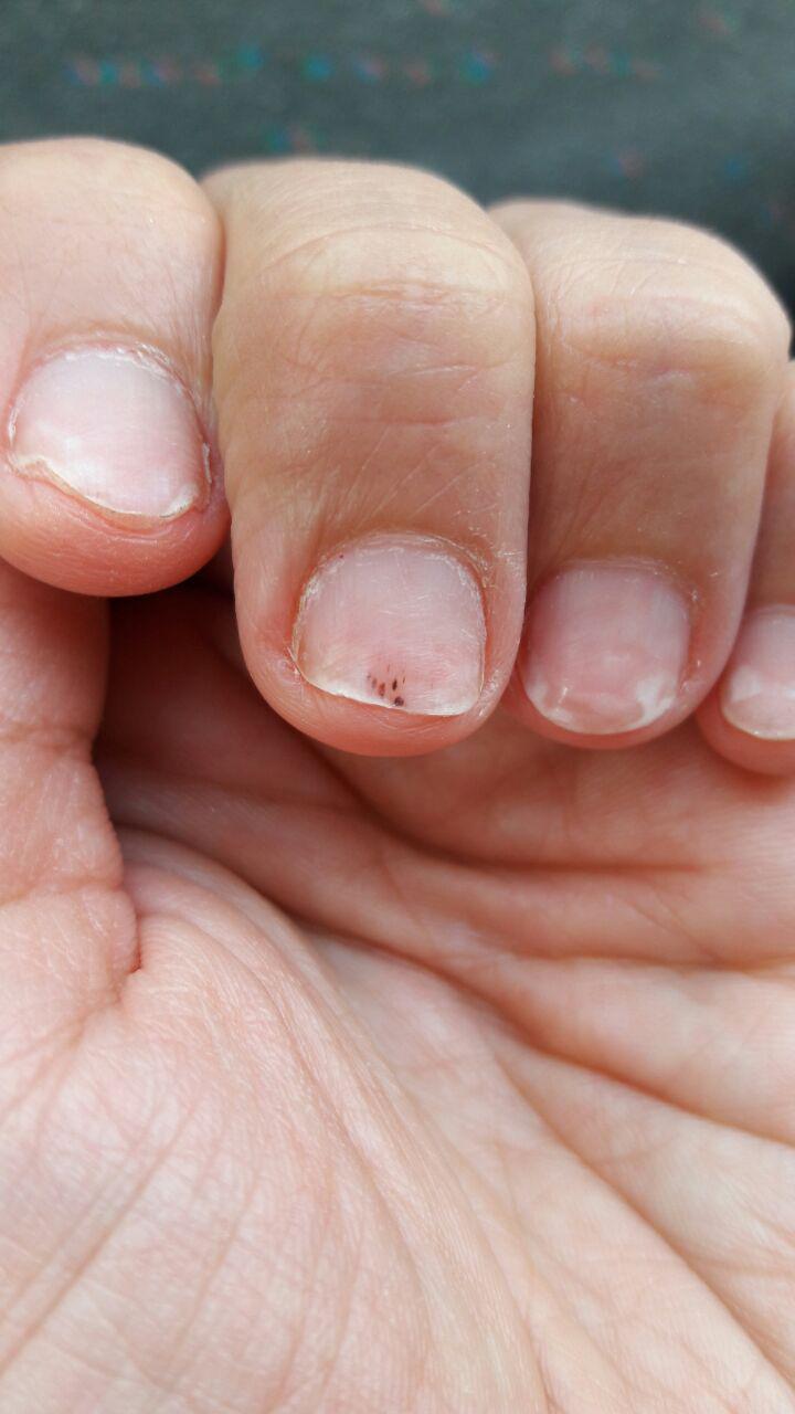 آموزش کاشت ناخن ، قارچ کاشت ناخن